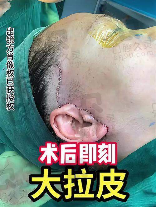 什么样的人群适合做SMAS除皱找王志军 医生？