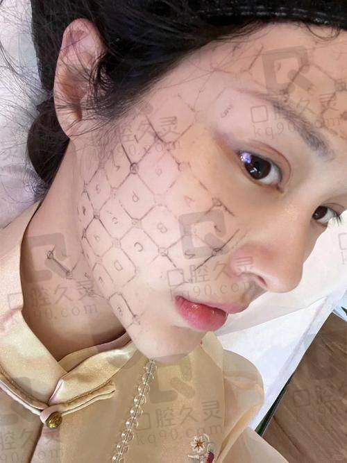 关于液态热玛吉的费用