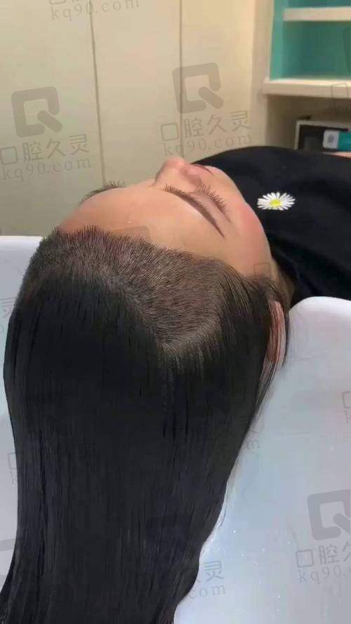 成都大麦和恒美植发哪个好？植发的费用、技术、医生团队及客户反馈等多个方面对比