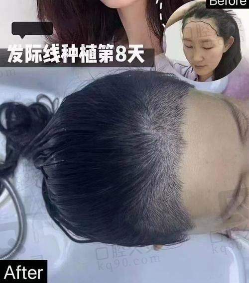 五、成都大麦与恒美植发的医生预约攻略