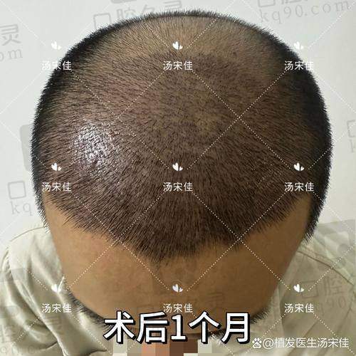 二、成都大麦与恒美植发的项目技术优势