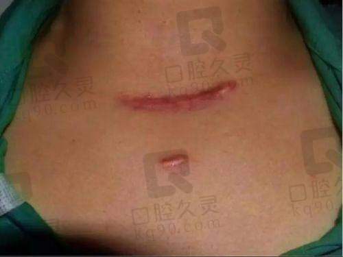 3. 软化疤痕类