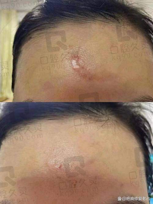 想知道重庆西南医院祛疤多少钱？这几个关键因素让价格一目了然！