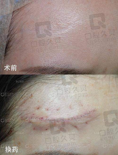 4. 特殊疤痕修复类