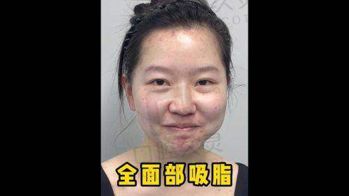 上海华美张朋面部脂肪填充手术风格