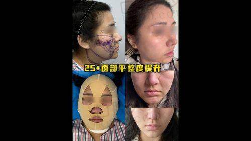 上海华美张朋面部脂肪填充的优势总结