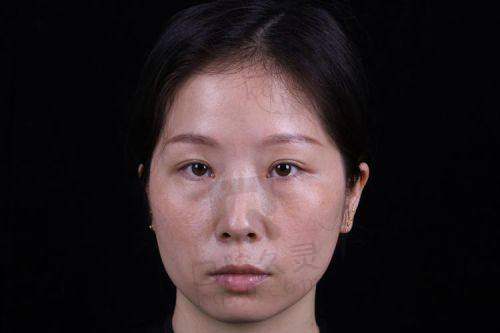 昆明美诗沁医美不开刀去眼袋是真的吗？我亲测从“熊猫眼”逆袭清爽靓颜！
