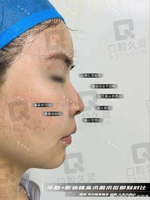 福州海峡美容医院做鼻子的术后成效如何？