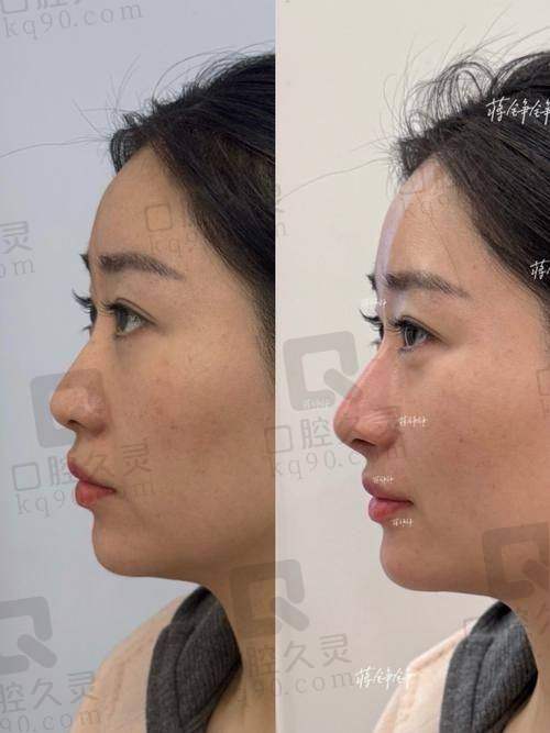福州海峡美容医院做鼻子的价格合理吗？