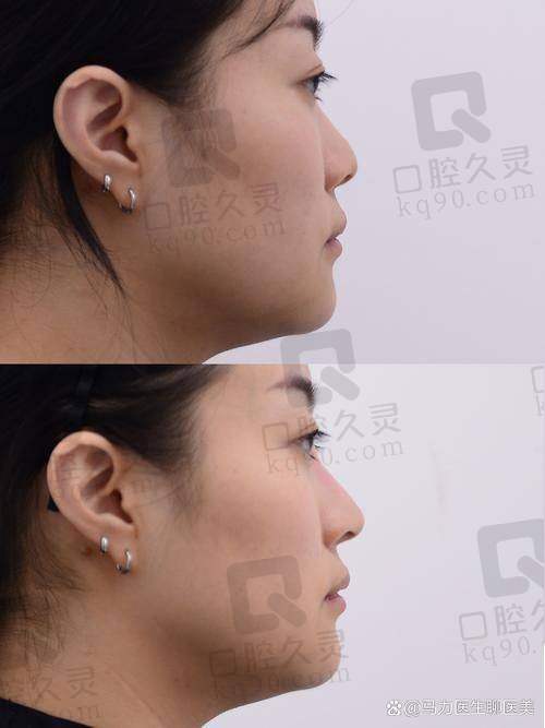 福州海峡美容医院做鼻子的技术水平如何？