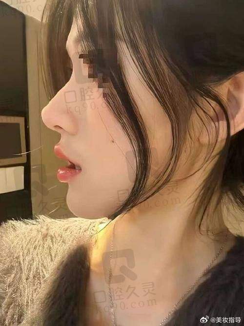 福州海峡美容医院做鼻子怎么样？专业团队、先进技术塑造自然美鼻效果佳 