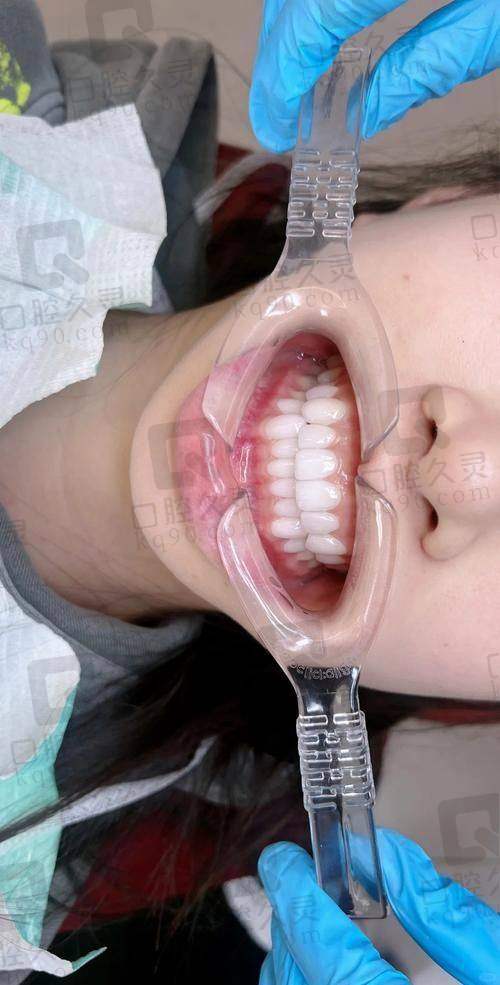 成都医大口腔半口8颗牙贴面套餐8880元起，多种技术材料加持美牙又实惠售后无忧