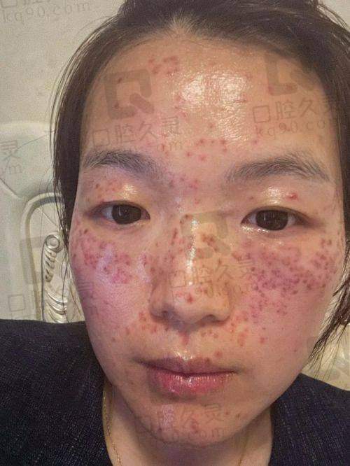 广州曙光整形医院祛斑前后要注意什么？