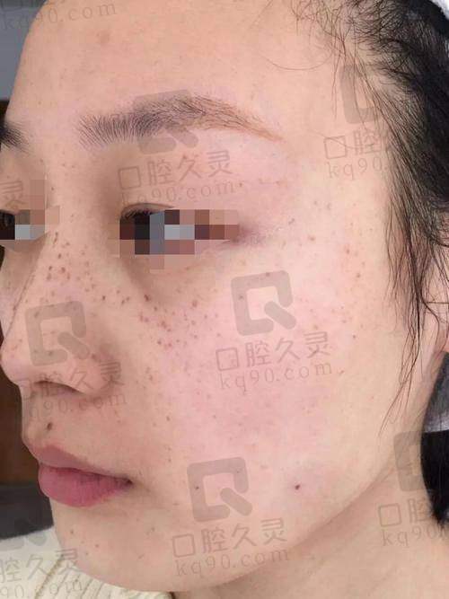 广州曙光整形医院祛斑价格表具体是怎样的？