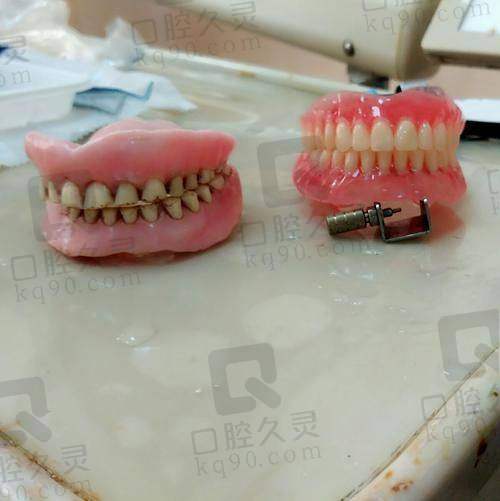 成都医大口腔医院老人安牙全口活动假牙采用了什么技术？
