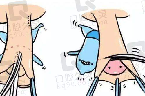 轻薄面塑造眶周/外轮廓项目解析