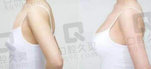 了解长沙雅美胸部整形技术特色