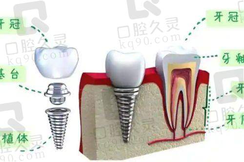 南通美奥口腔医院种植牙的技术优势体现在哪里？