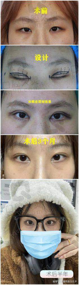 端木雪峰医生双眼皮修复实例分析