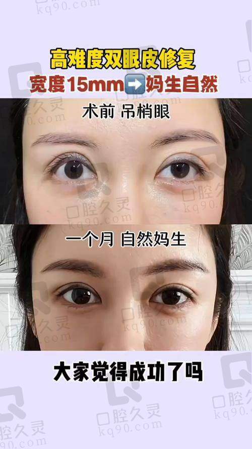 五、术前术后注意事项