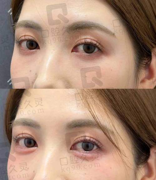 郑州王杨医生眼袋修复卧蚕真的很好吗？15年经验+微创技术+高满意度给出肯定答案 