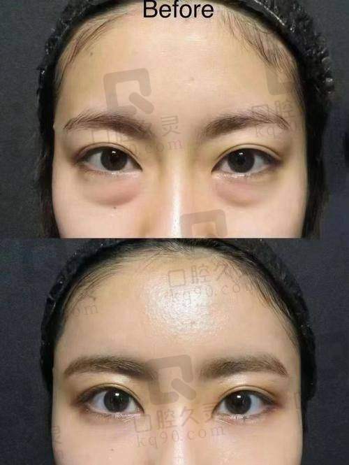 广州健丽美诗沁祛眼袋靠谱吗？技术优、服务佳、口碑好助你告别眼袋烦恼 