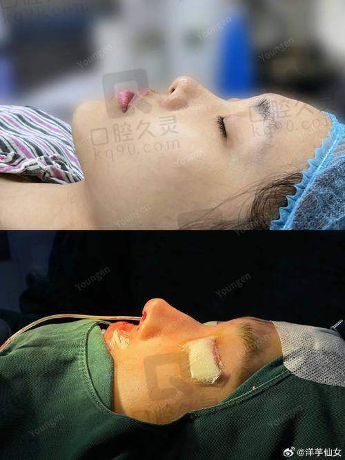 湛江韩美整形医院做鼻子靠谱吗？杨开波医生单侧耳软骨隆鼻效果自然又真实 