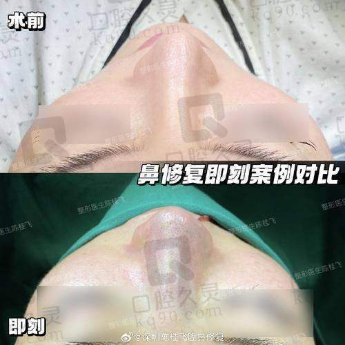 湛江韩美整形医院鼻整形医生实力