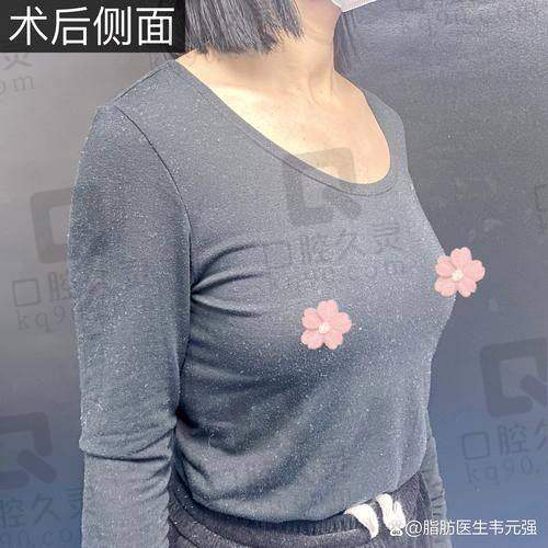 长沙雅美胸部整形体验分享，专业技术塑造理想胸型，术后美感与自信双提升 