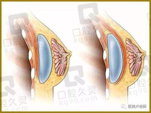四、湛江韩美医院自体脂肪隆胸项目优势