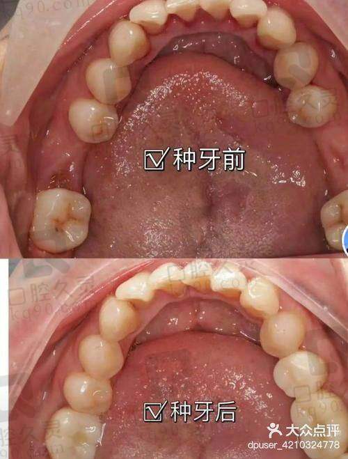 南通美奥口腔医院与其他口腔医院相比，种植牙价格有优势吗？