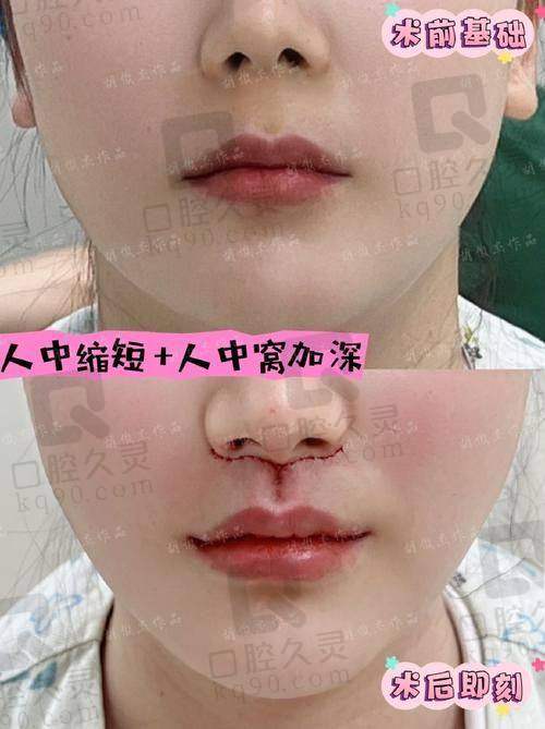 技术细节对比（手术过程 + 缝合方法）