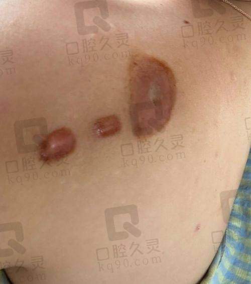 苏州乐桥疤痕研究院收费高吗？再看收费透明度与医疗保险政策