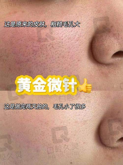 湛江韩美黄金微针2000元起，紧致肌肤、淡化瑕疵，多效合一焕新美肌！