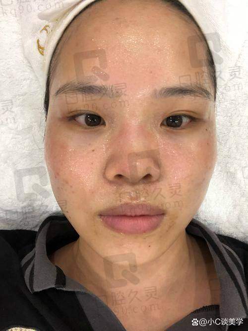长沙雅美果酸换肤的成效能持续多久？