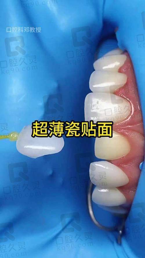牙齿贴面美白是怎么回事？