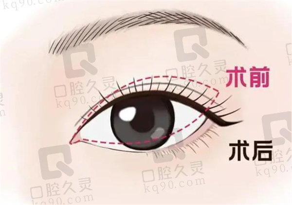 佛山美莱医疗王燕什么大学毕业的？中山大学毕业14年眼鼻整形经验成就不是有技术