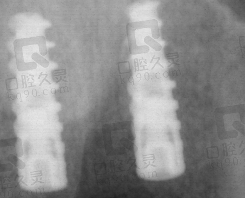 种植牙后的成效和感受如何？