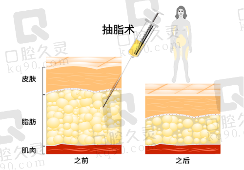 广州中家医家庭医生赵慧慧英伦大提升4710元起，术后成效显著