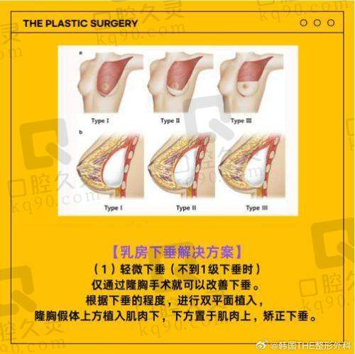 广州中家医家庭医生朱云乳房下垂矫正29750元起——性价比之选