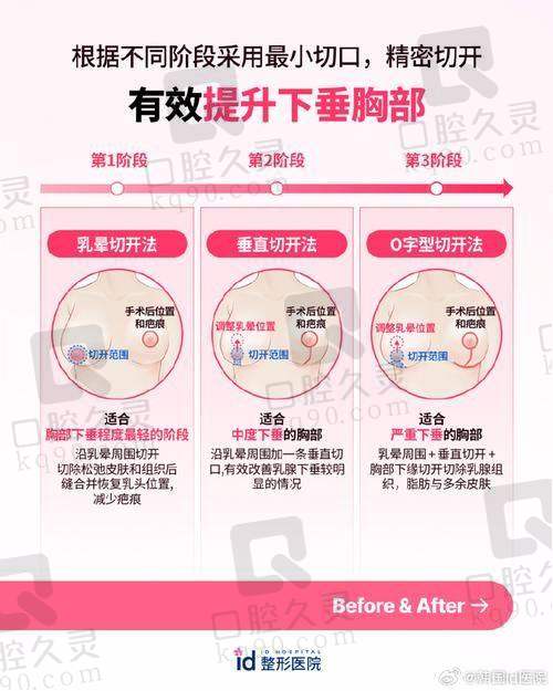 朱云医生的蘑菇瓣技术——乳房下垂矫正的优选