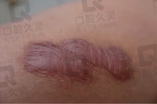 台州艺星疤痕增生修复体验：淡化增生痕迹，重拾肌肤自信，恢复过程超安心 
