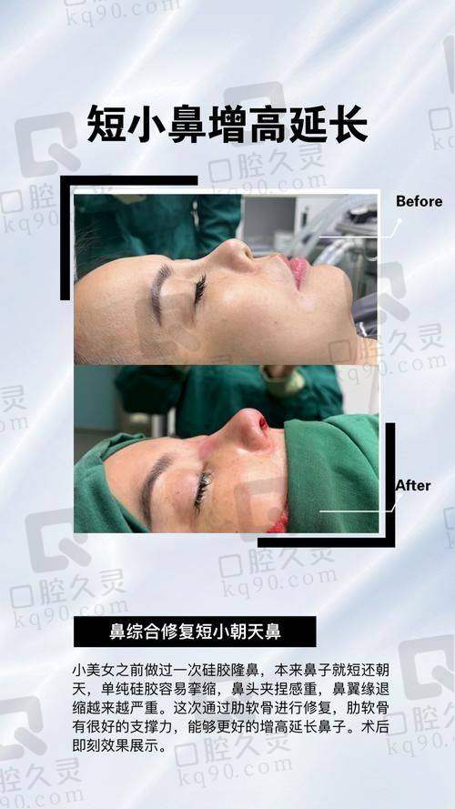 广州中家医家庭医生易普锋硅胶假体隆鼻的流程解析