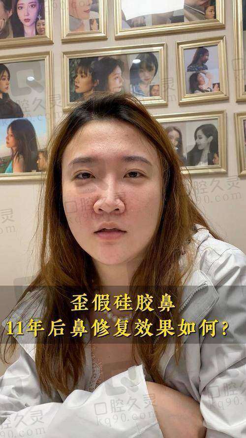 广州中家医家庭医生易普锋硅胶假体隆鼻的实例分析
