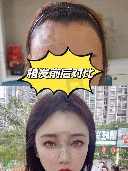 石家庄美莱医疗美容整形医院植发吗？正规设备、专业团队助您实现理想植发效果！