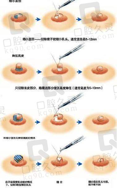 广州中家医家庭医生朱云乳头缩小6750元起的行业影响