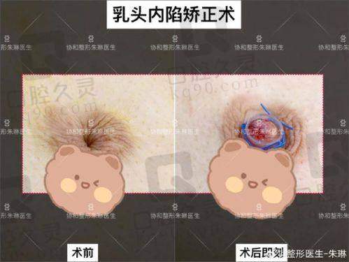 广州中家医家庭医生朱云乳头缩小6750元起的成功实例