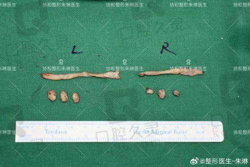 广州中家医家庭医生朱云乳头缩小6750元起的价格分析
