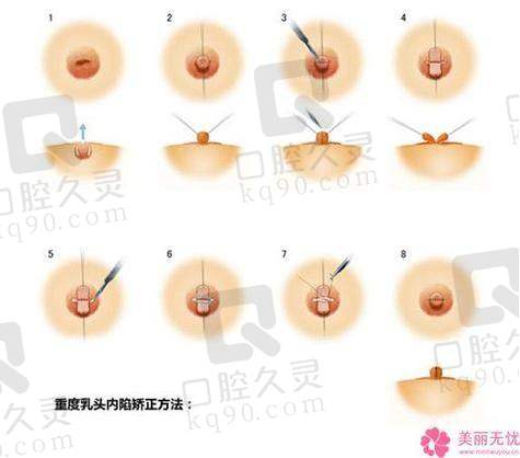 广州中家医家庭医生朱云乳头缩小6750元起的精良技术