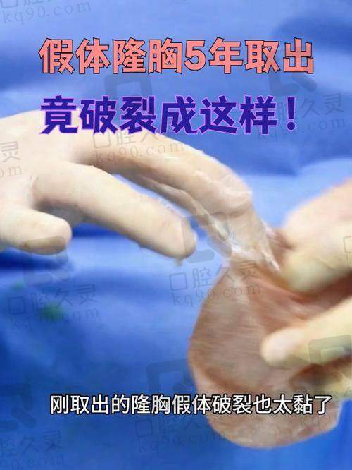 广州中家医家庭医生朱云胸部假体取出5750元起，减少术后并发症和修复时间